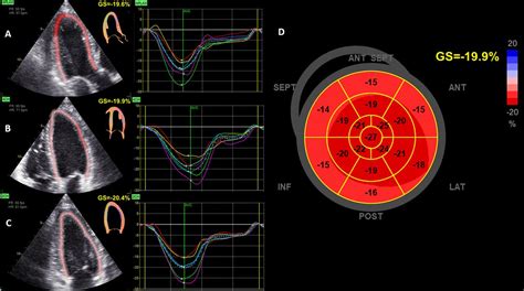 reduced global longitudinal strain